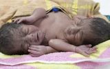 تولد دوقلوی به هم چسبیده در بنگلادش