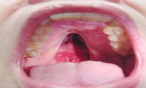 شیوع سرطان دهان، مراقب باشید!