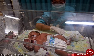 تولد نادر یک نوزاد ۲ سر در اندونزی+ تصاویر