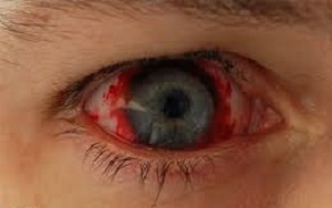 مردی که لنزهای زیبایی چشم‌هایش را کور کرد/ انگل، عامل عفونت چشم در استفاده کنندگان لنز