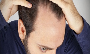 کلاه باعث کچلی در پسران می شود/ ریزش مو شدید به دلیل دم‌اسبی کردن موها!