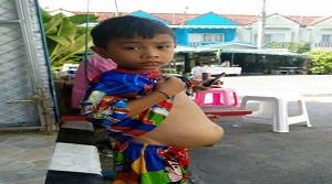 تومور سرطانی وحشتناک، کودک تایلندی را زمین‌گیر کرد + تصاویر