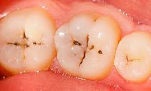 ماندگاری غذا برروی سطح دندان مهم‌ترین عامل پوسیدگی