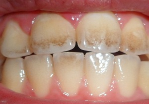 جرم‌گیری دندان با ۶ ماده طبیعی و موثر خانگی