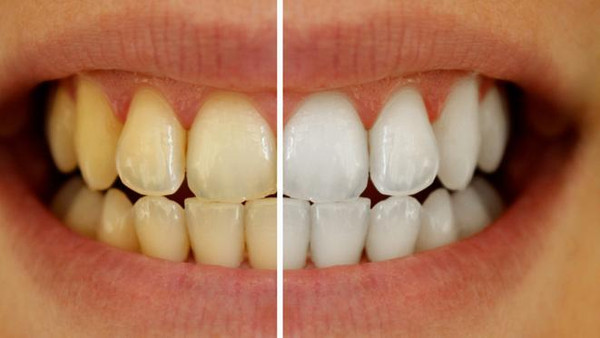 راهکارهای طلایی برای سفید کردن دندان‌ها